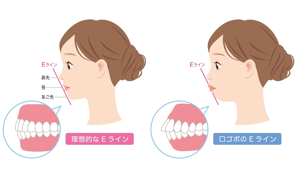 そもそも「口ゴボ」とは？どうして目立つのか