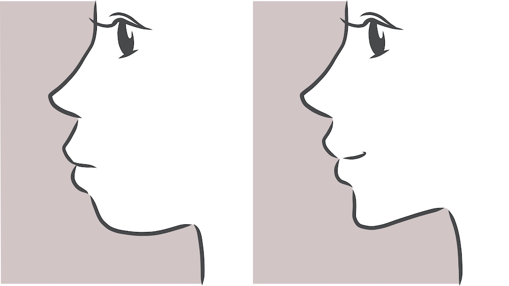 出っ歯でも裏側矯正はできる？できない？