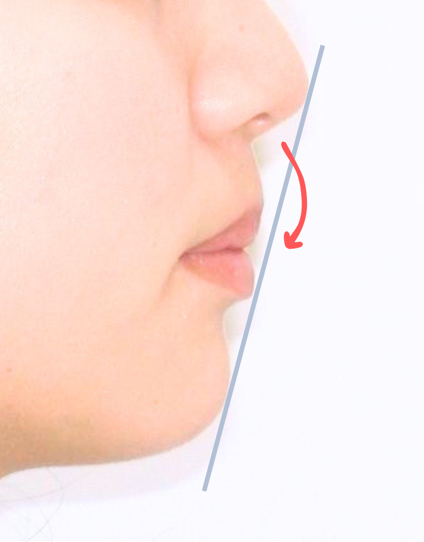 治療前症例写真_口元