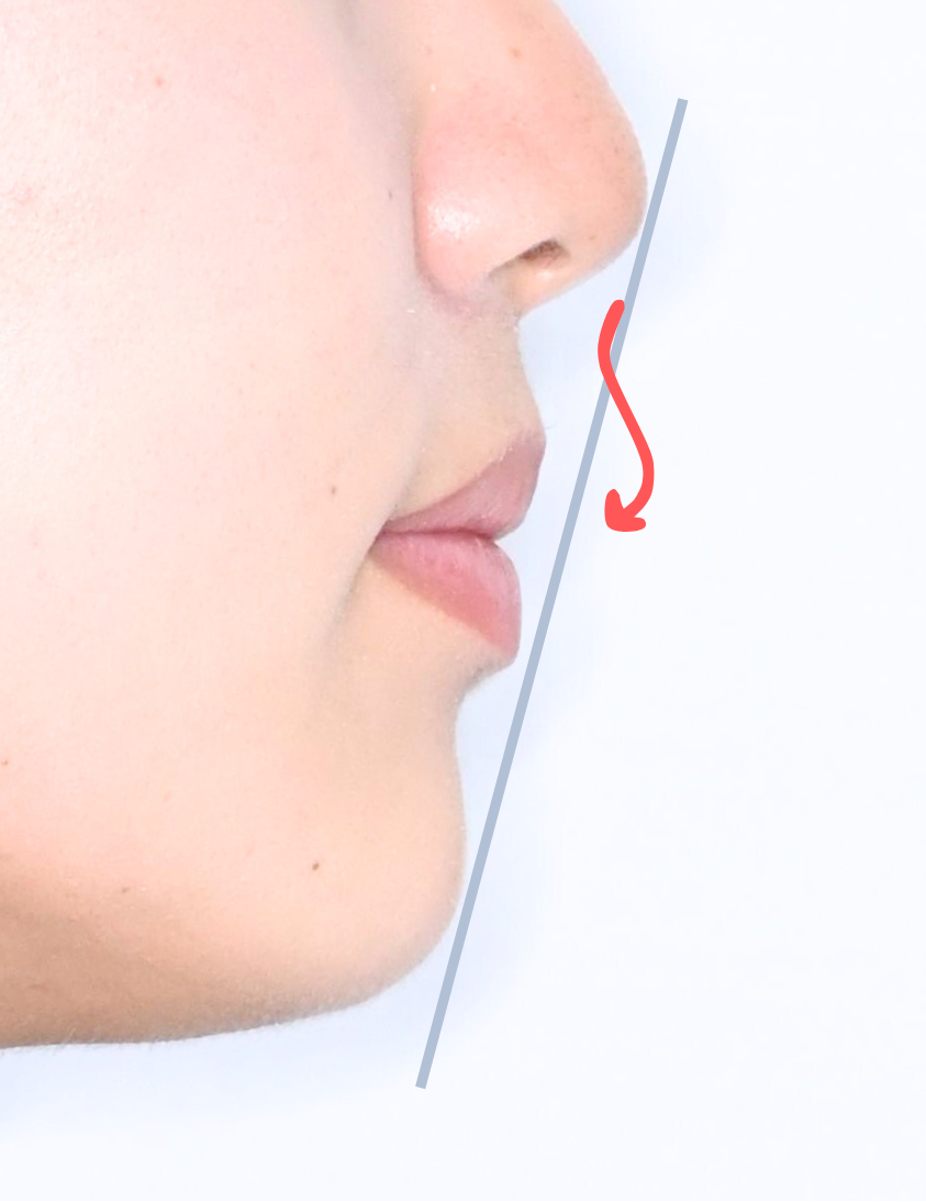 治療後症例写真_口元