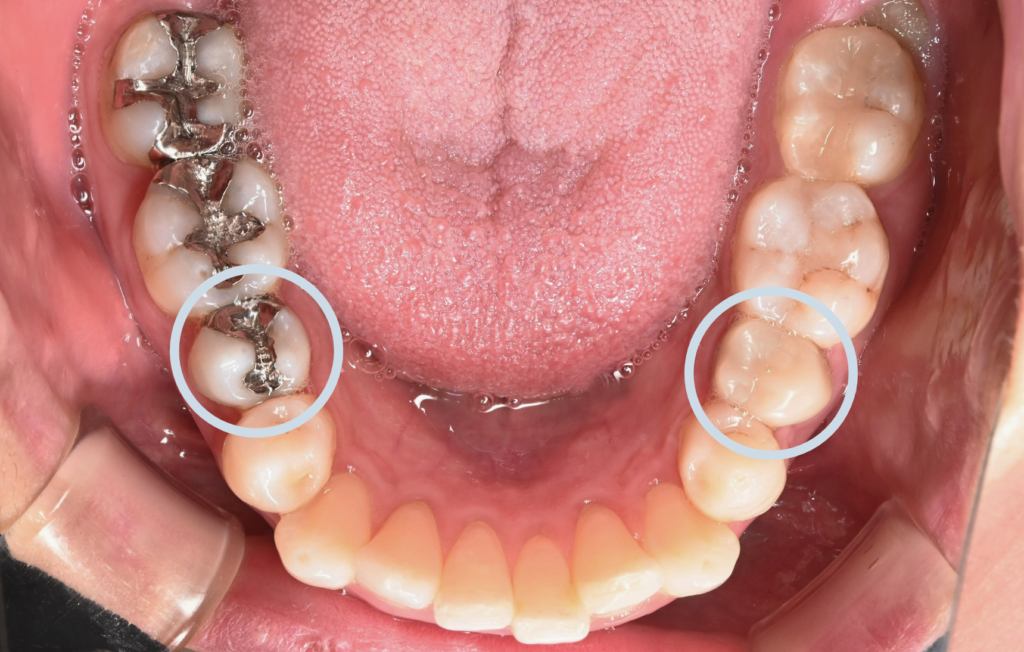 症例写真：抜歯箇所_下