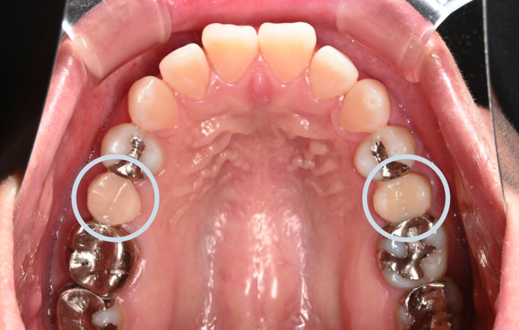 症例写真：抜歯箇所_上