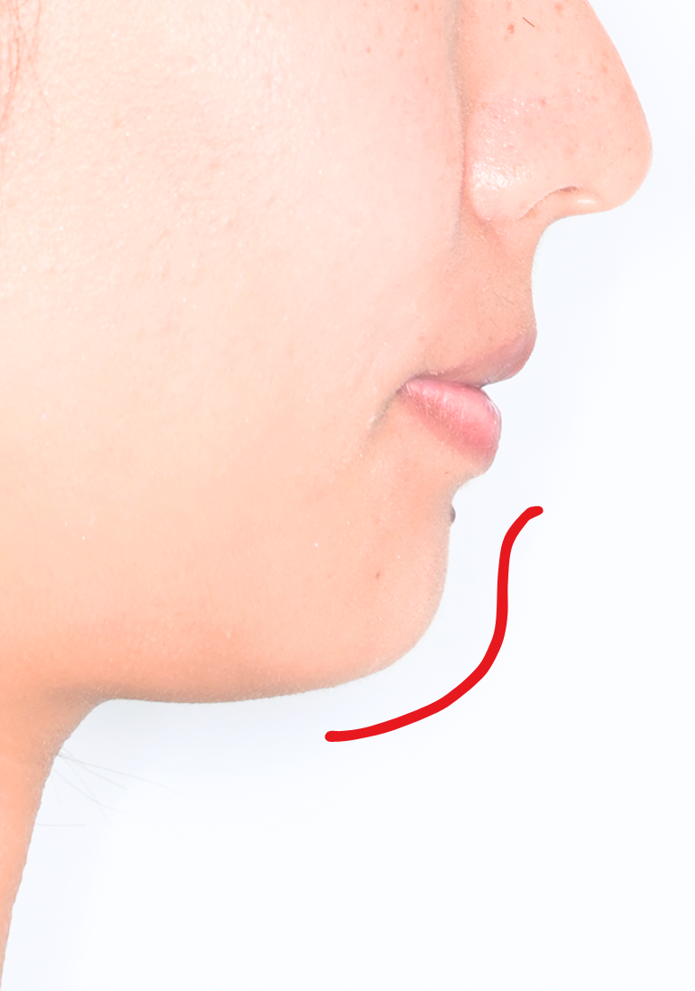 治療後症例写真_横顔