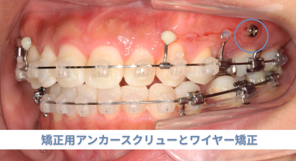 矯正用アンカースクリューとワイヤー矯正
