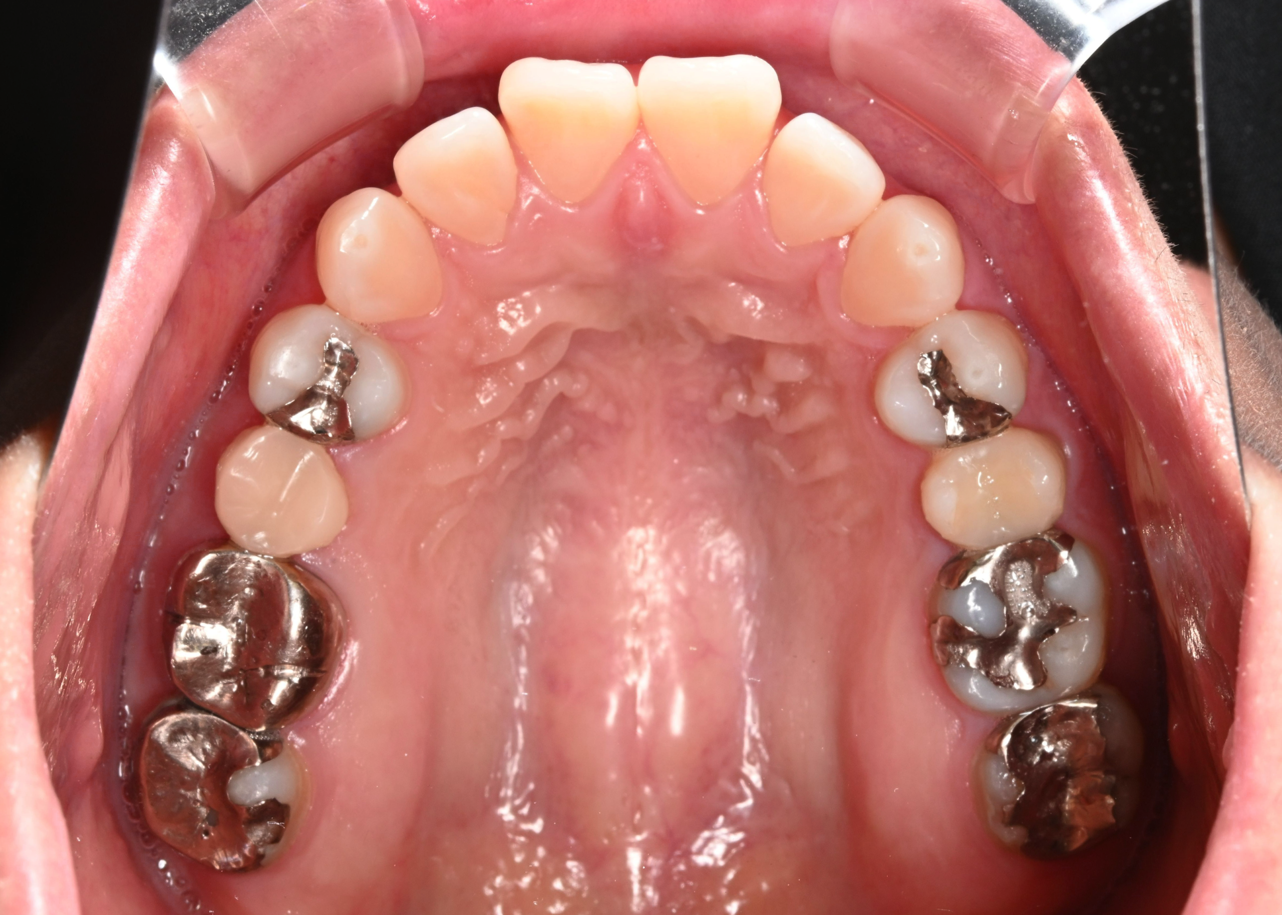 治療前症例写真_上