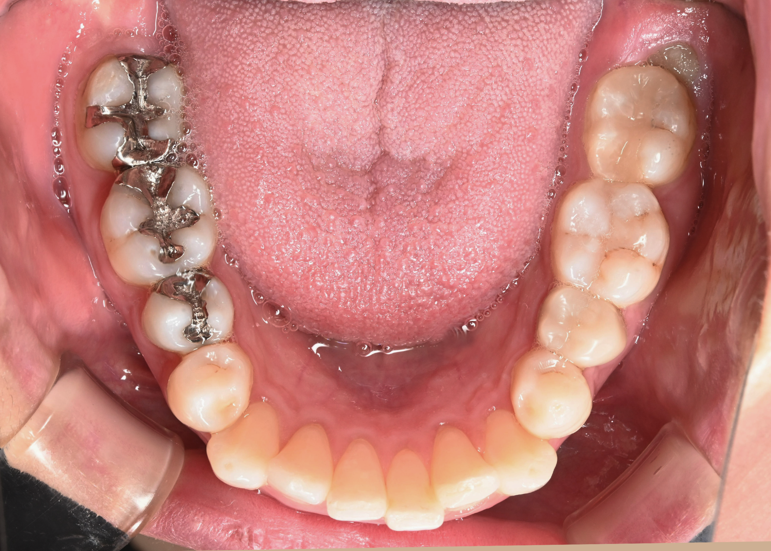 治療前症例写真_下