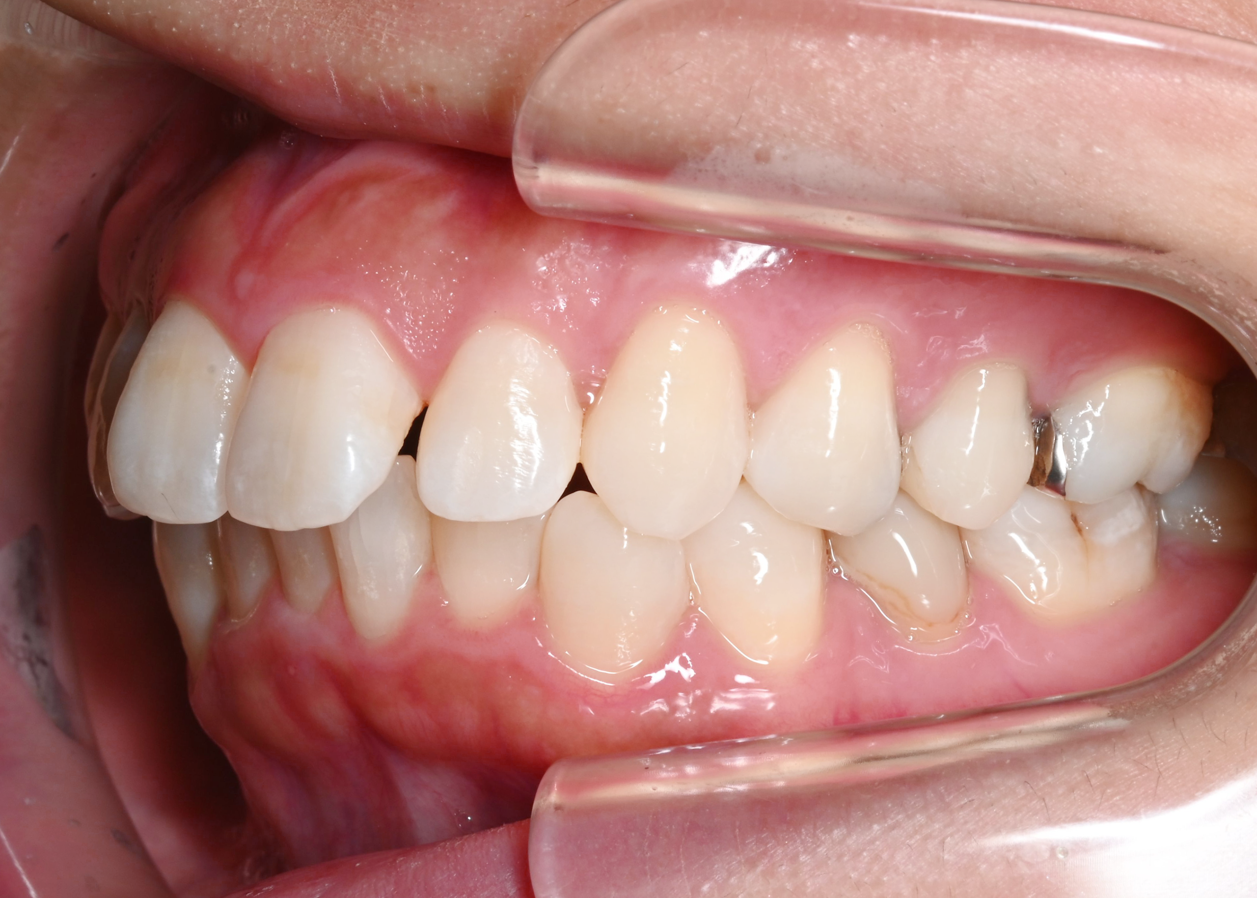 治療前症例写真_右