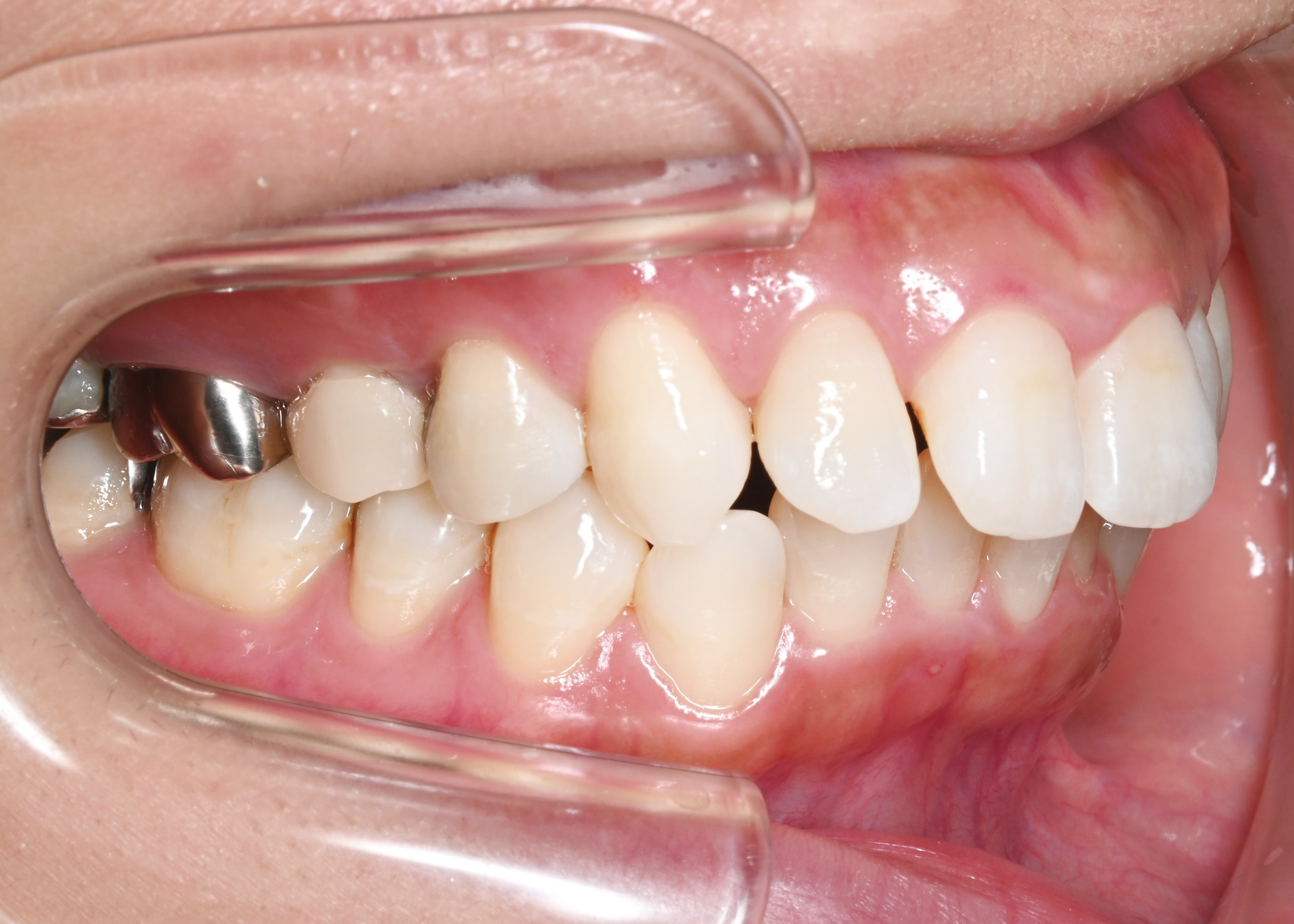 治療前症例写真_左