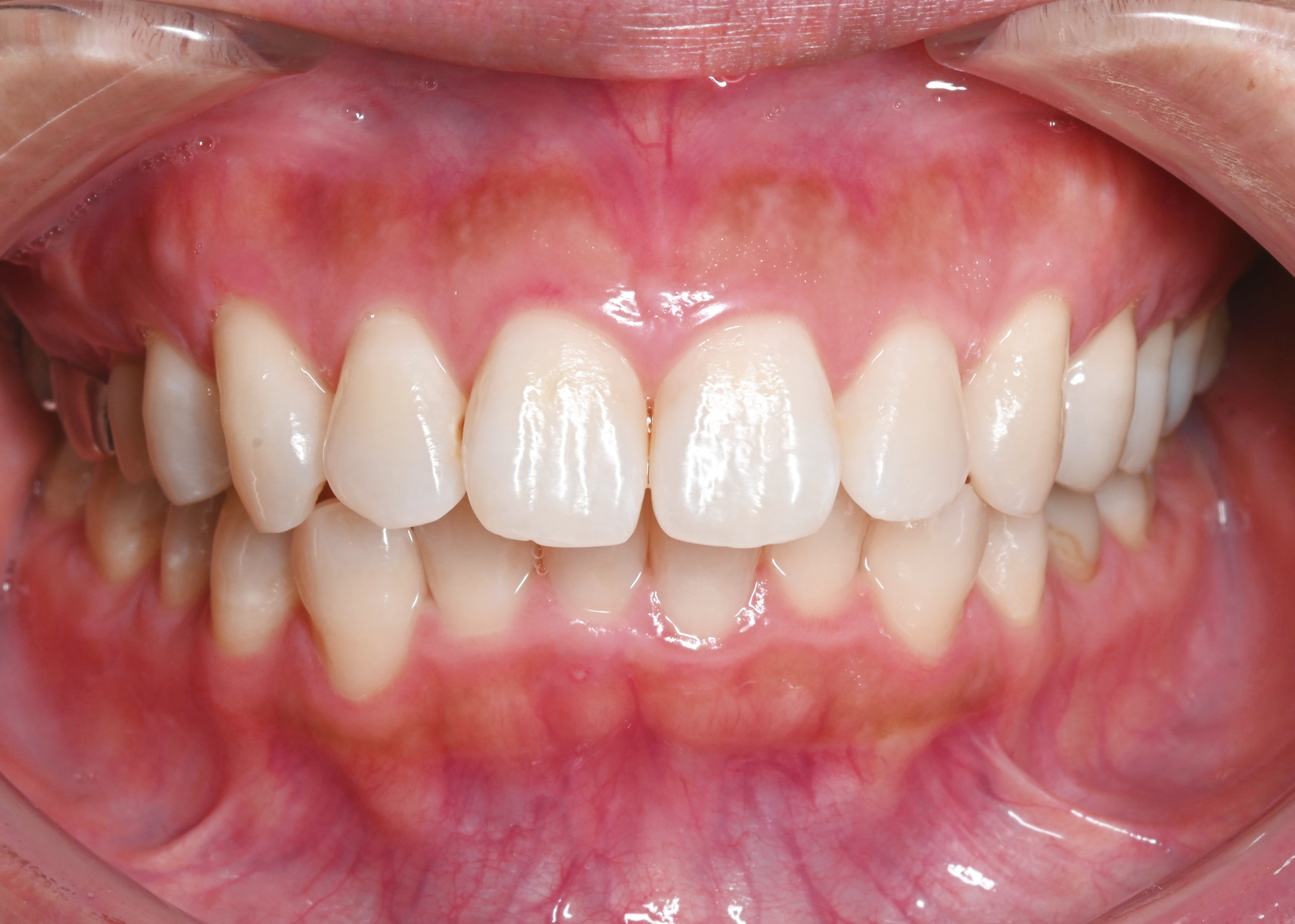 治療前症例写真_正面