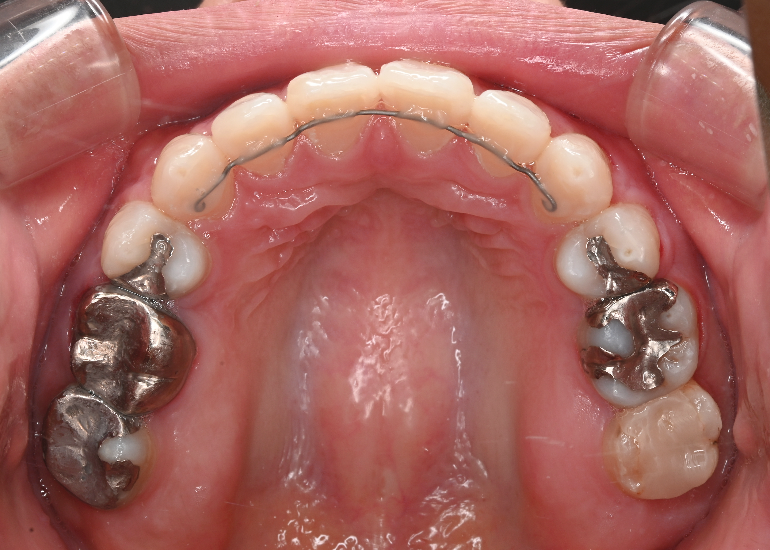 治療後症例写真_上