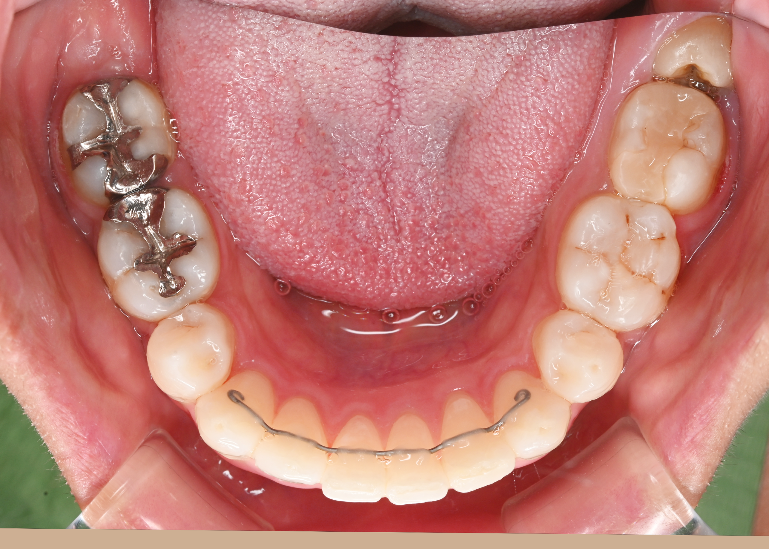 治療後症例写真_下