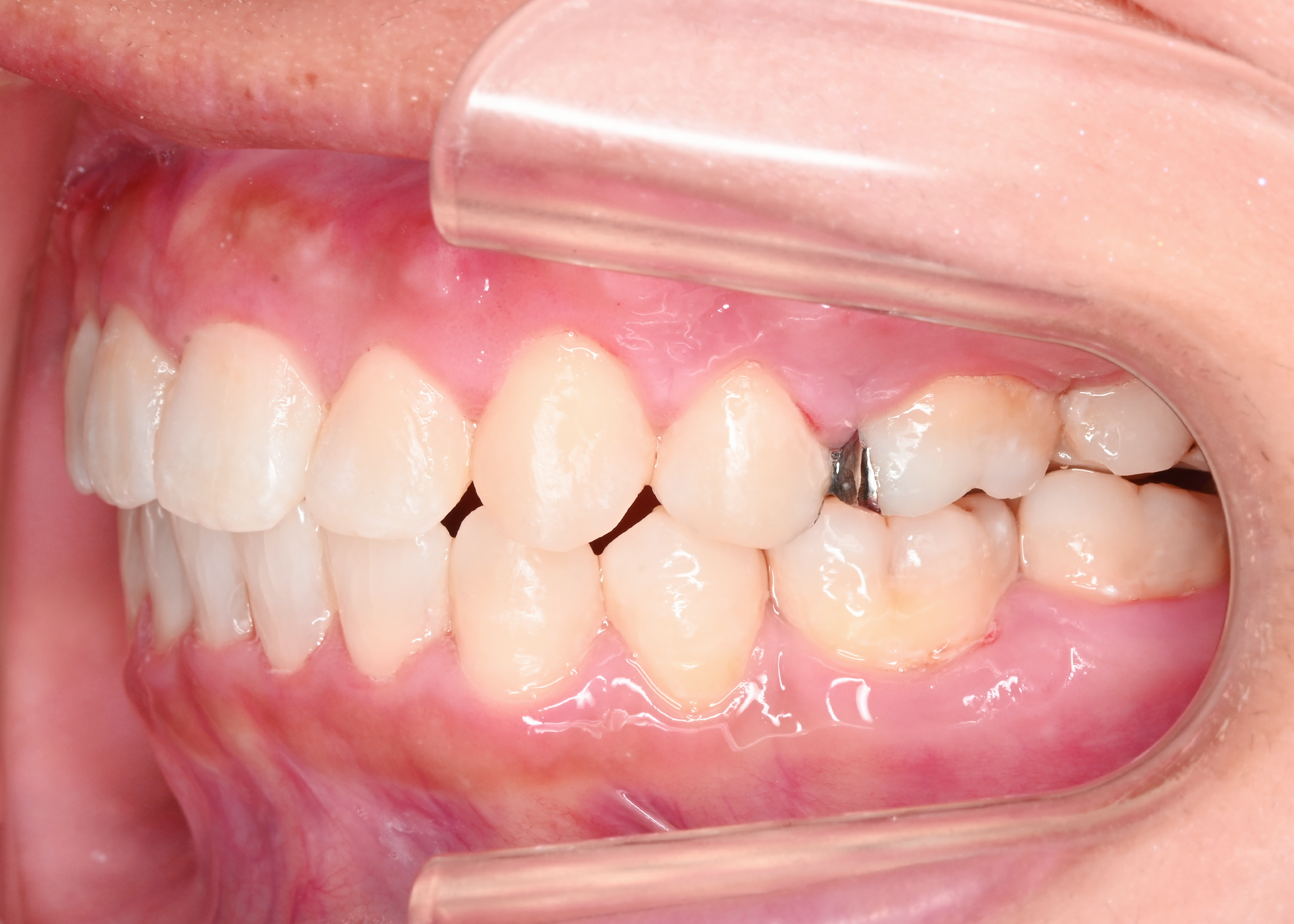 治療後症例写真_右