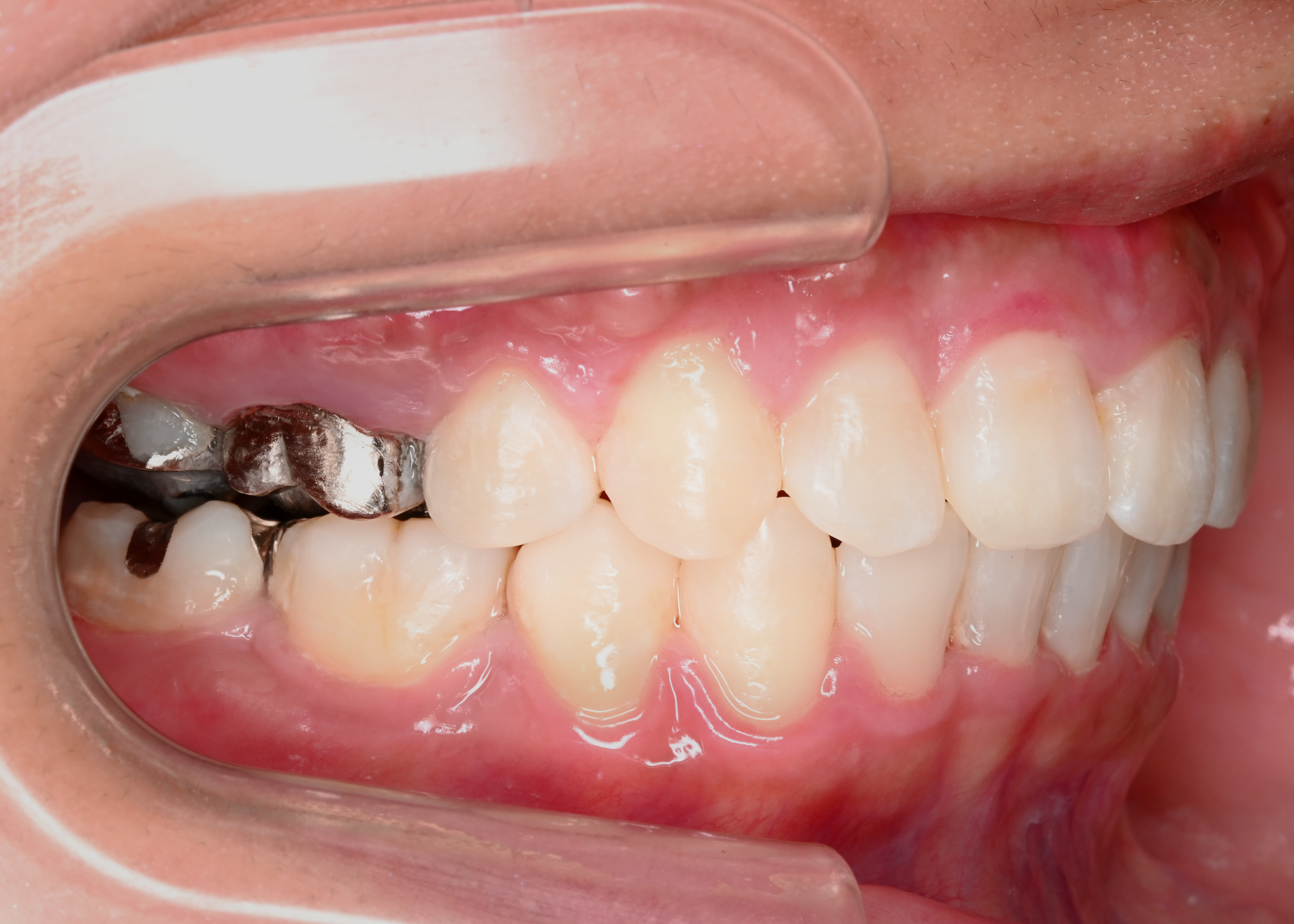 治療後症例写真_左