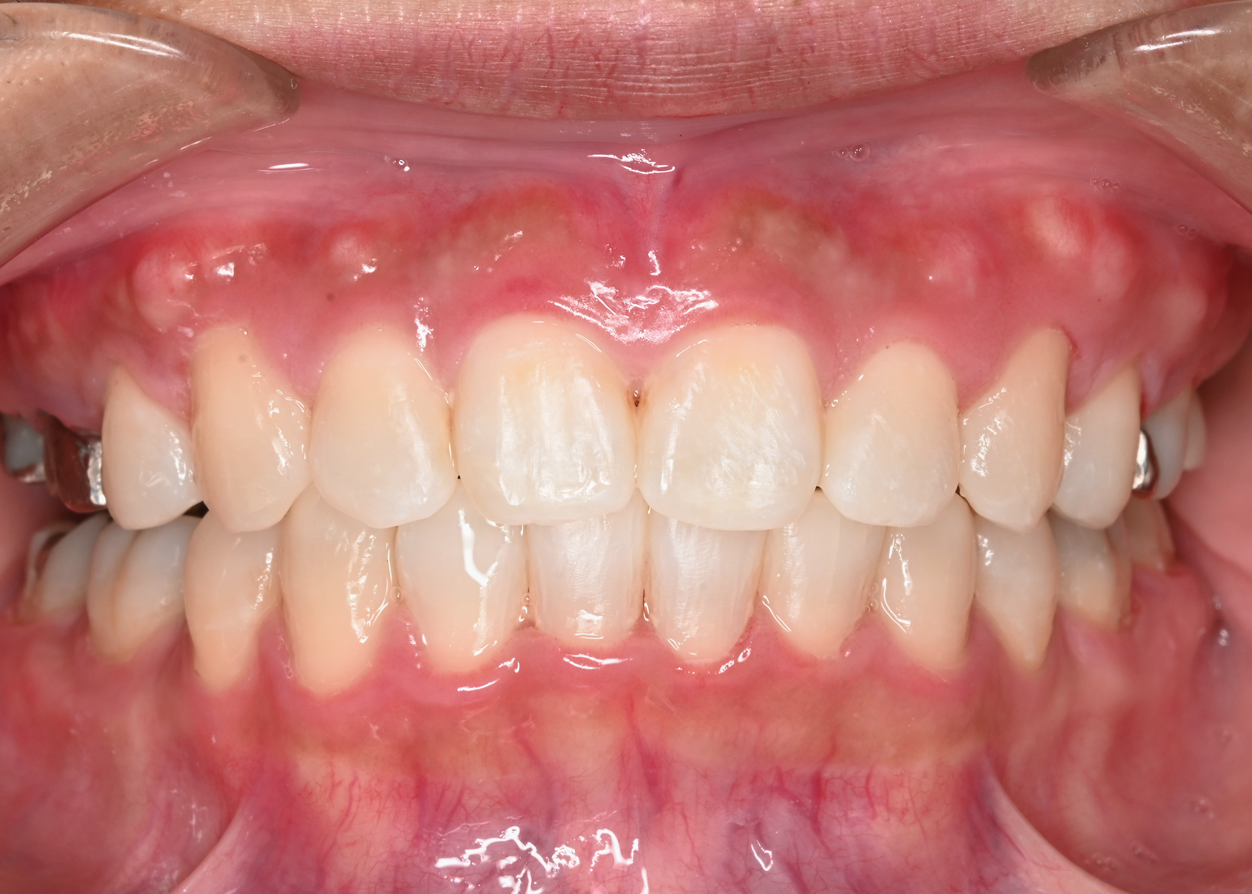 治療後症例写真_正面