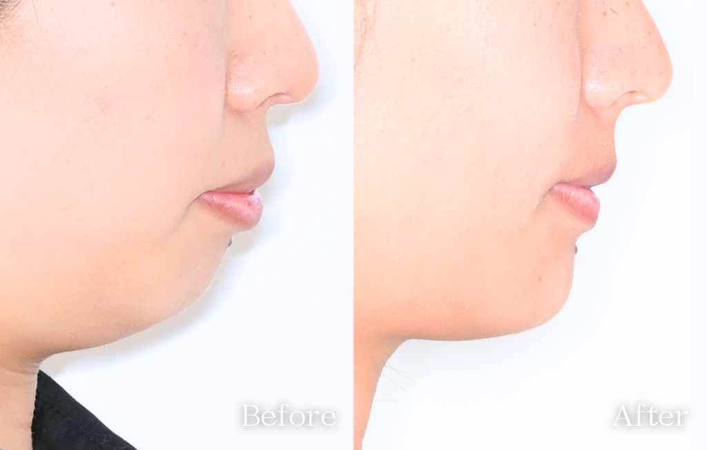 矯正コラム 口ゴボ矯正期間 Before After写真