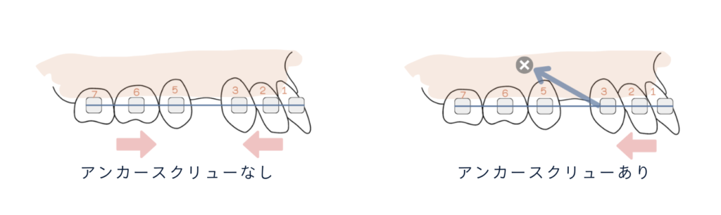 アンカースクリューイメージ画像