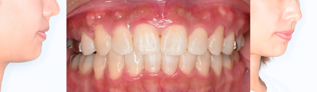 コラム 口ゴボ矯正期間治療後の写真