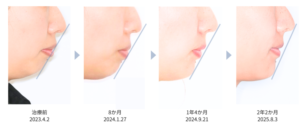 コラム 口ゴボ矯正期間 全期間の横顔の変化