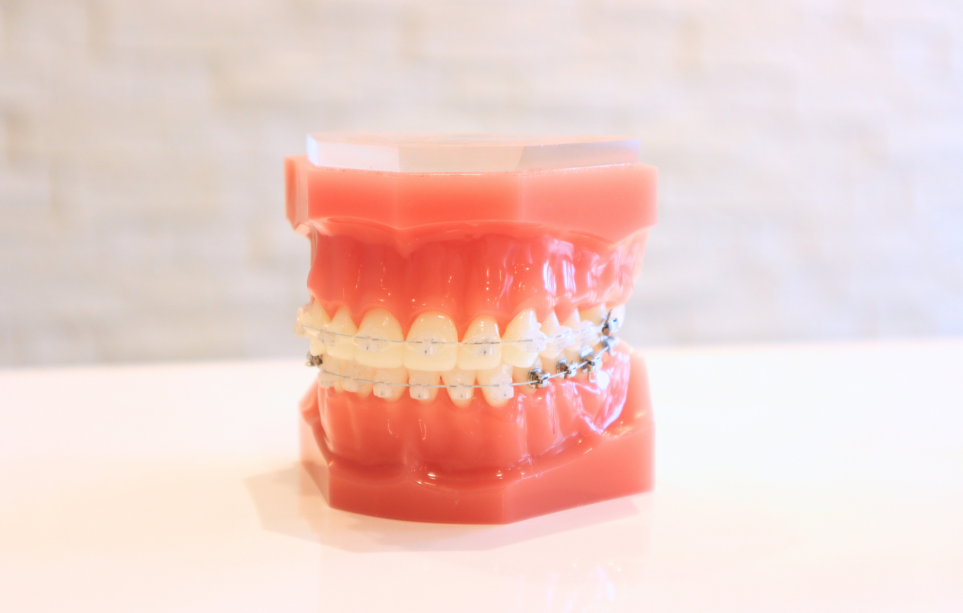 矯正模型　表側ワイヤー矯正