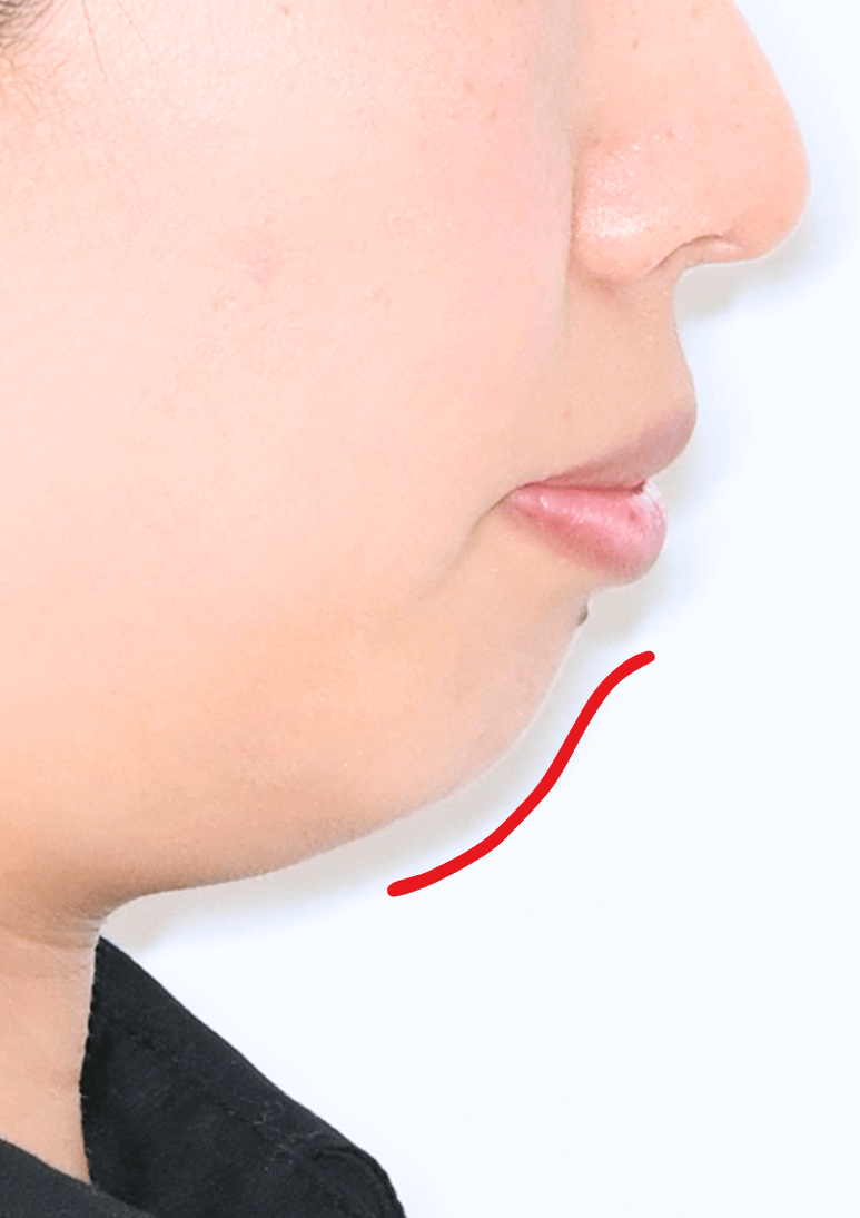 治療前症例写真_横顔