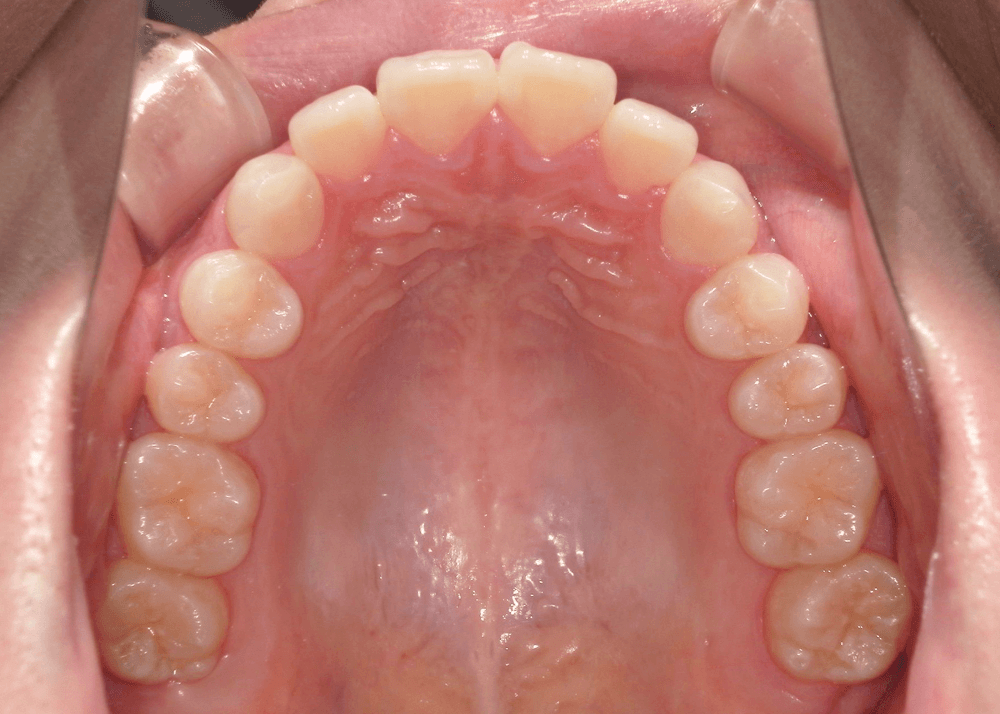 治療前症例写真_上