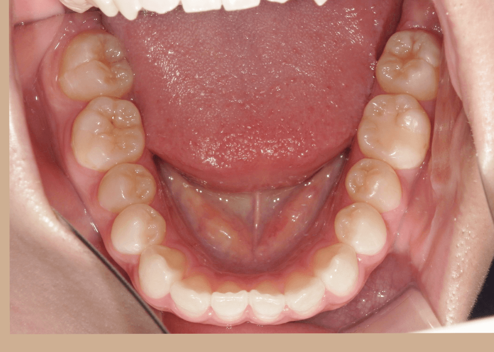 治療前症例写真_下