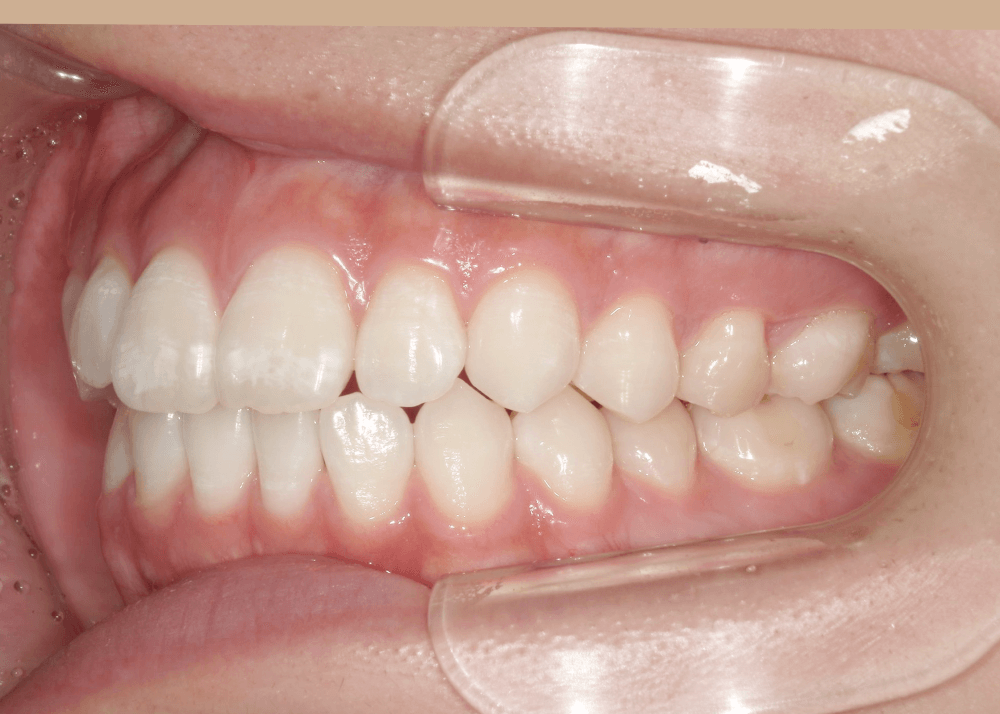 治療前症例写真_右