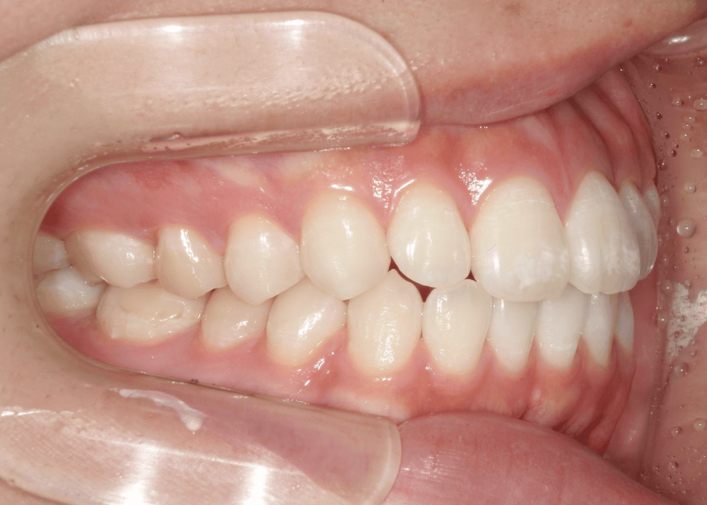 治療前症例写真_左