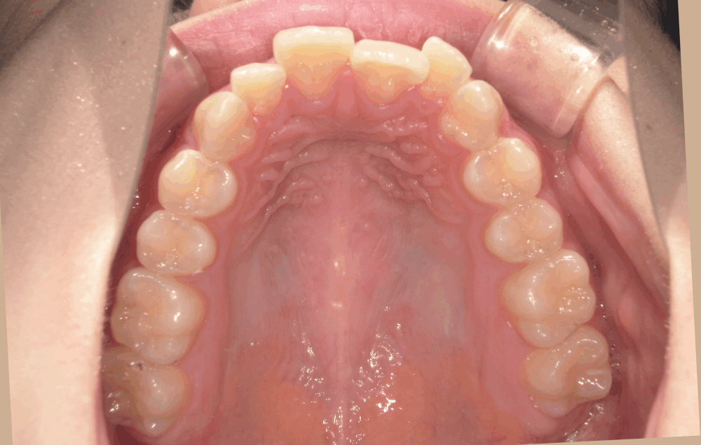 治療前症例写真_上