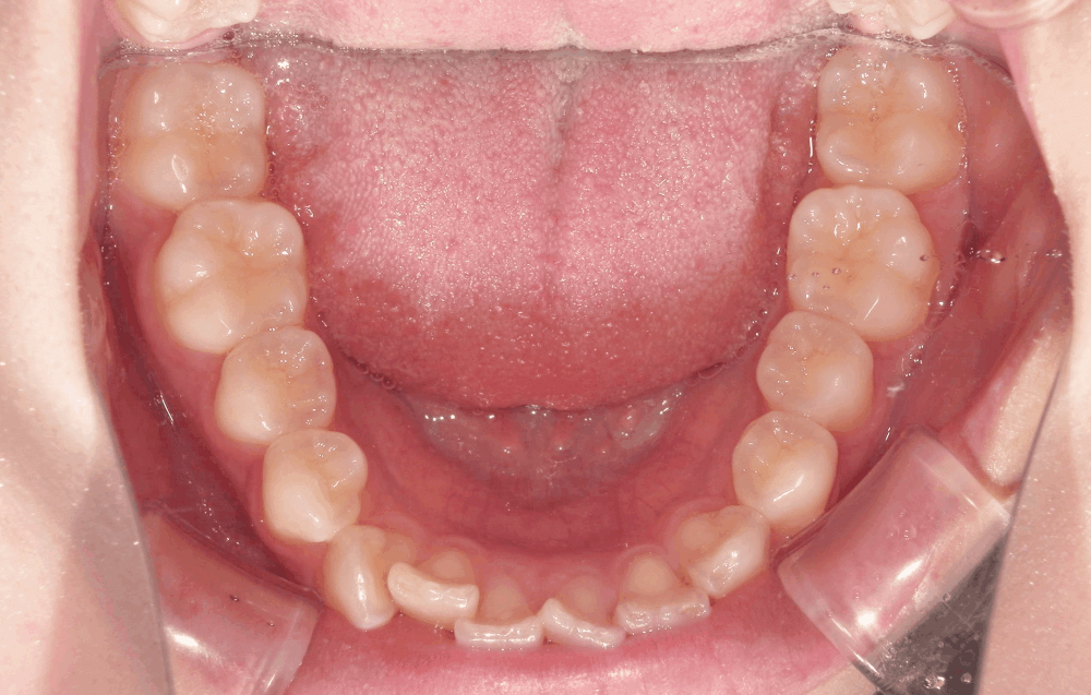 治療前症例写真_下