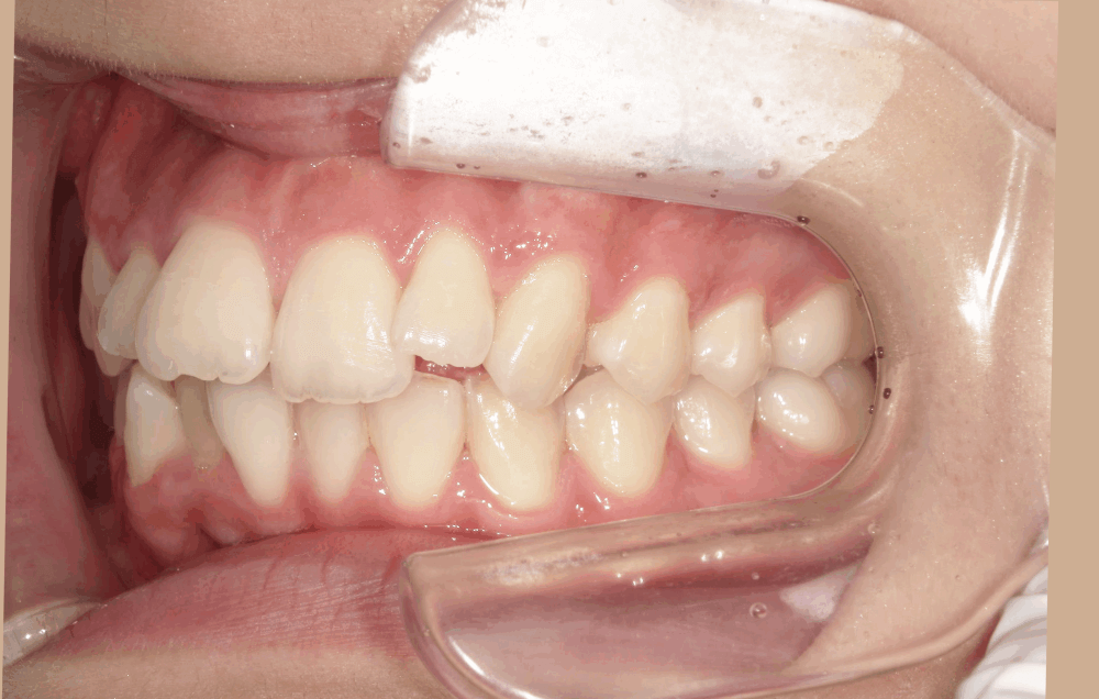 治療前症例写真_右