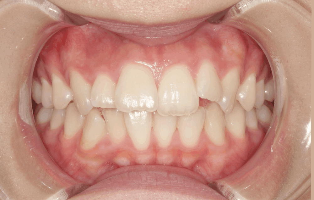 治療前症例写真_正面