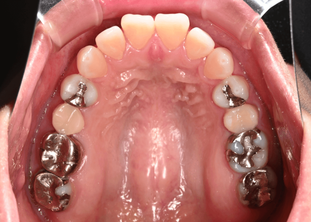 治療前症例写真_上