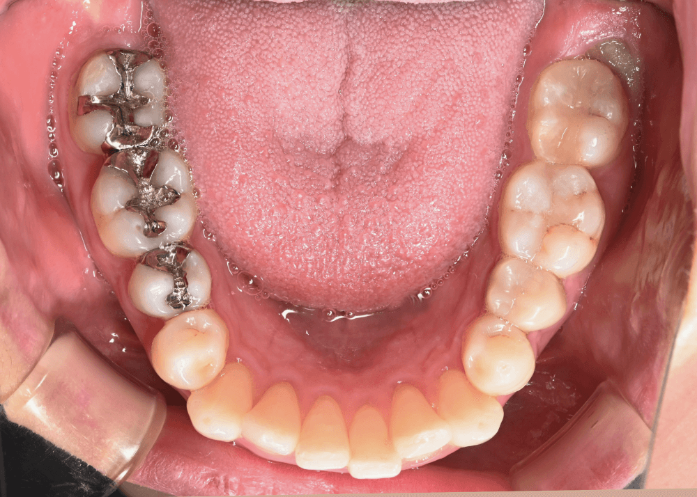 治療前症例写真_下