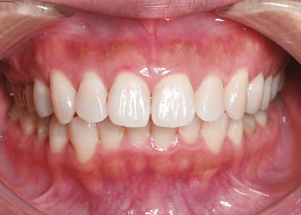 治療前症例写真_正面