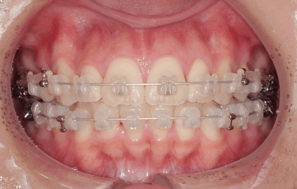 表側ワイヤー矯正治療中（ホワイトワイヤー/セラミックブラケット使用