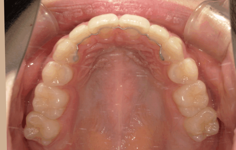 治療後症例写真_上