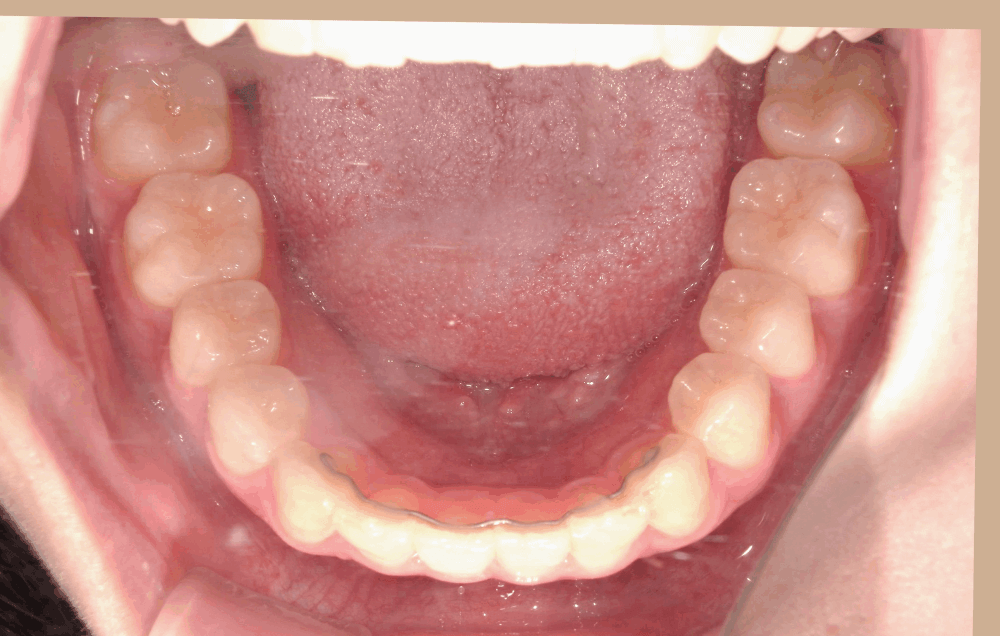 治療後症例写真_下