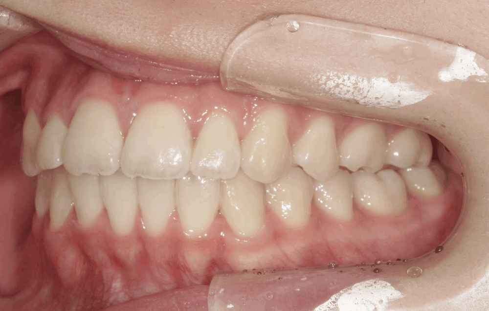 治療後症例写真_右