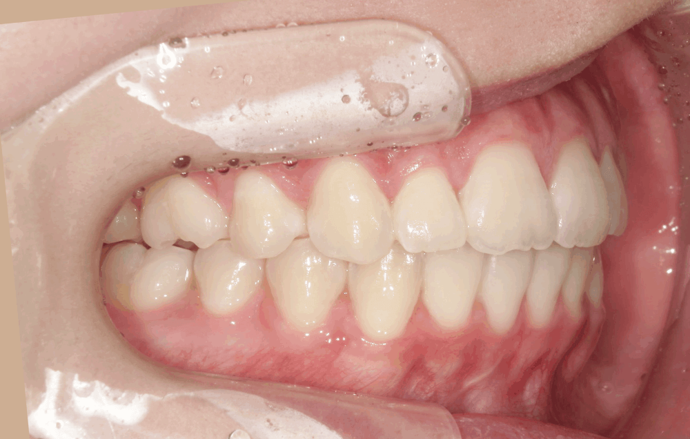 治療後症例写真_左