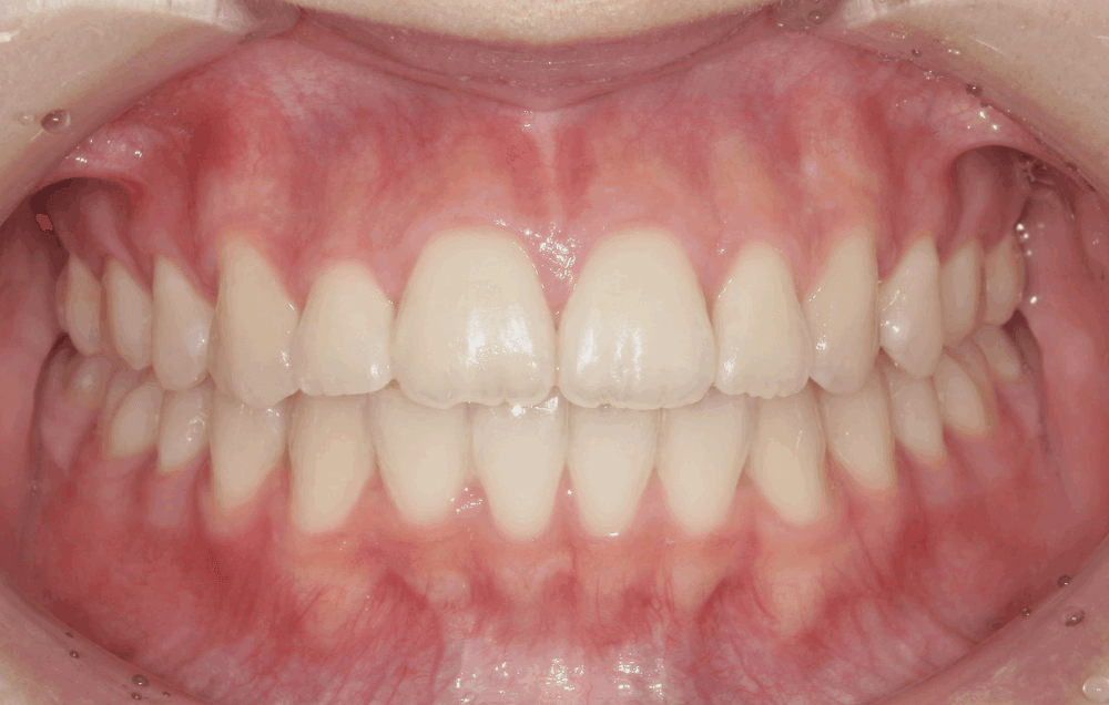 治療後症例写真_正面