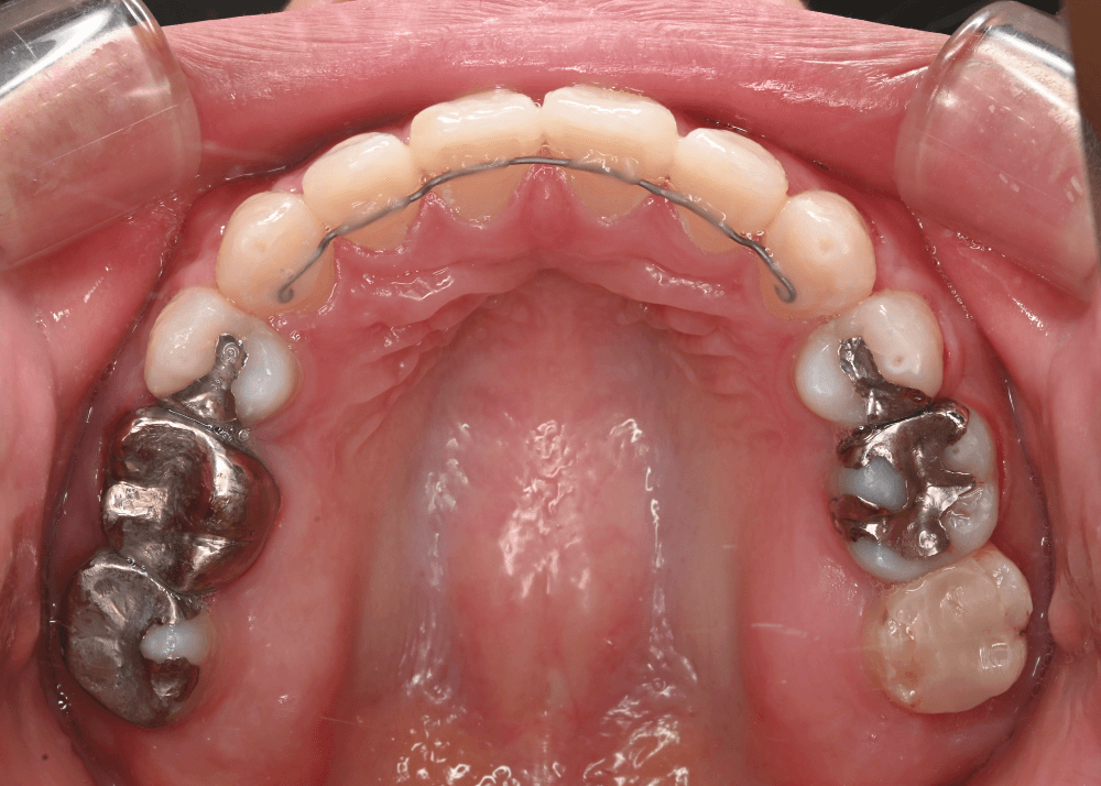 治療後症例写真_上