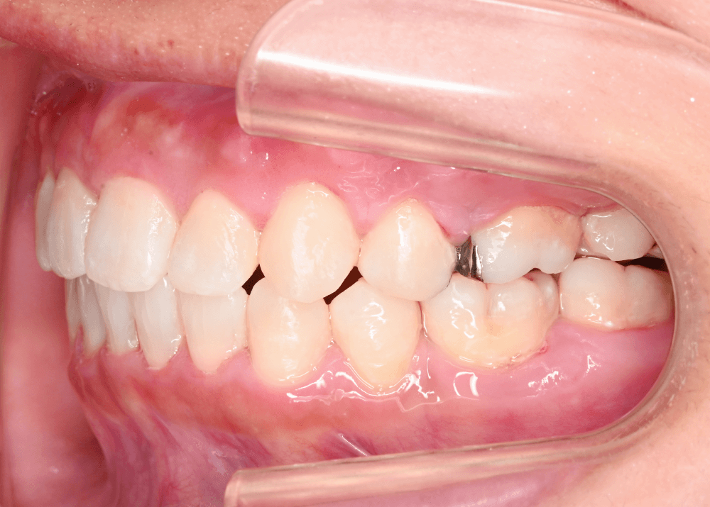 治療後症例写真_右