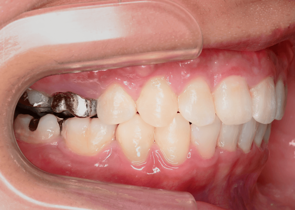 治療後症例写真_左