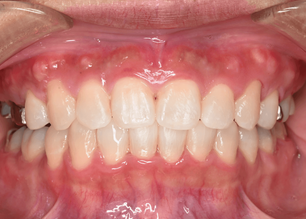 治療後症例写真_正面