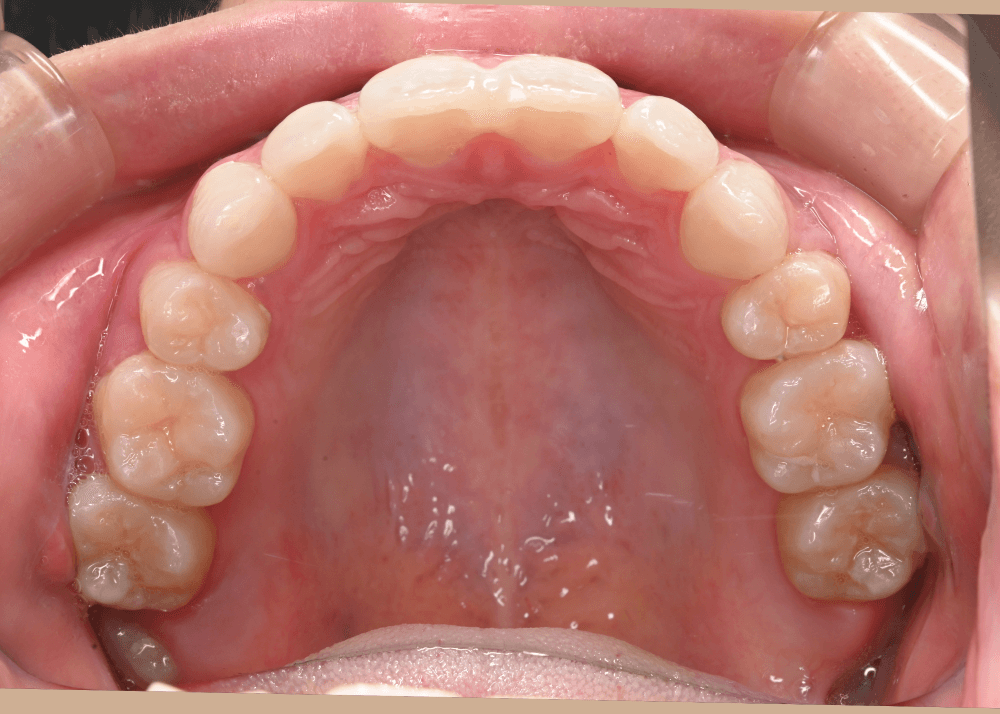 治療後症例写真_上