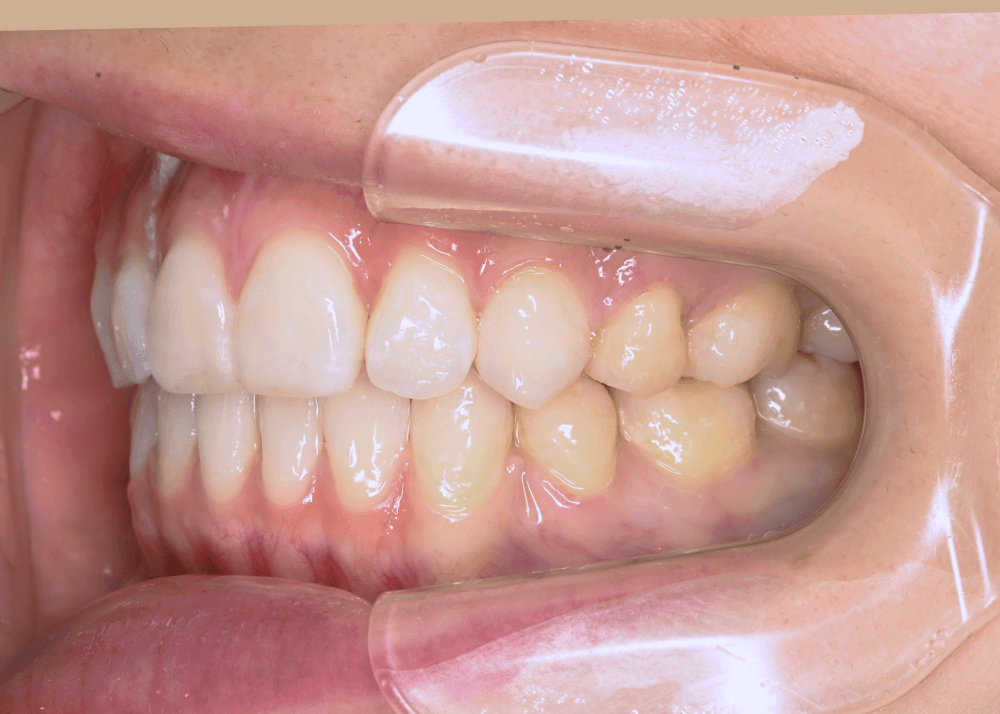 治療後症例写真_右