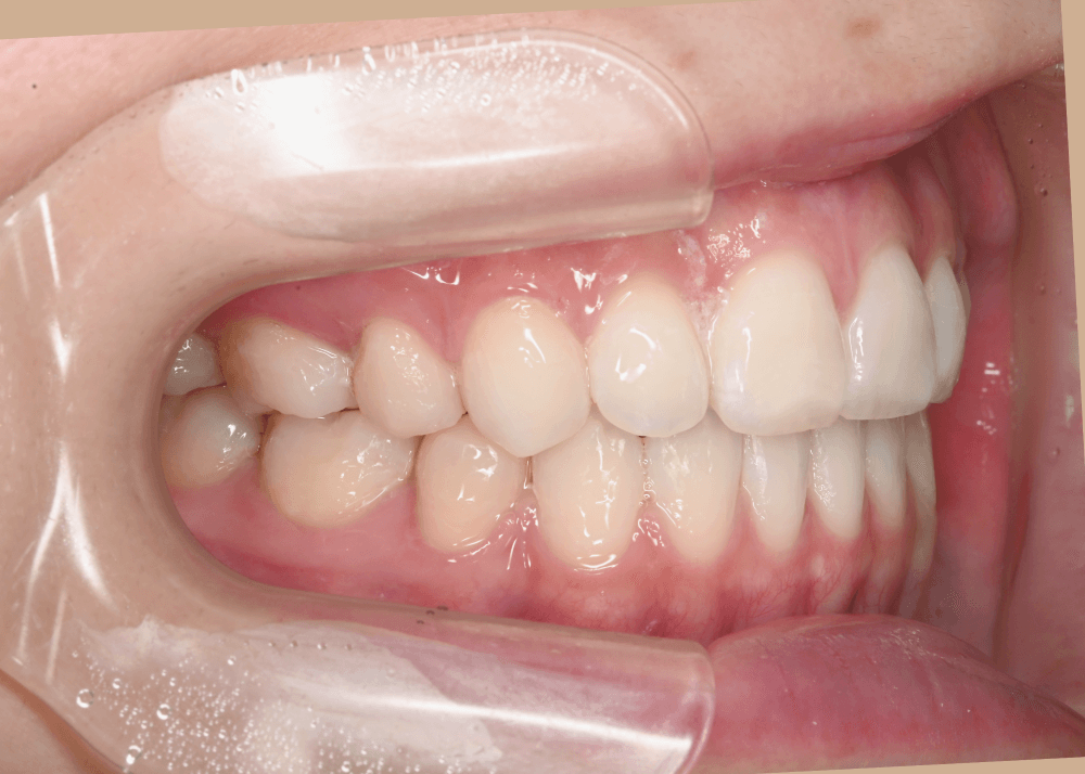 治療後症例写真_左