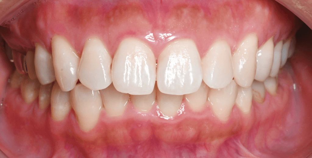 症例写真：治療前_正面