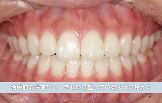 治療前の歯並び①:きれいに整っているように見える